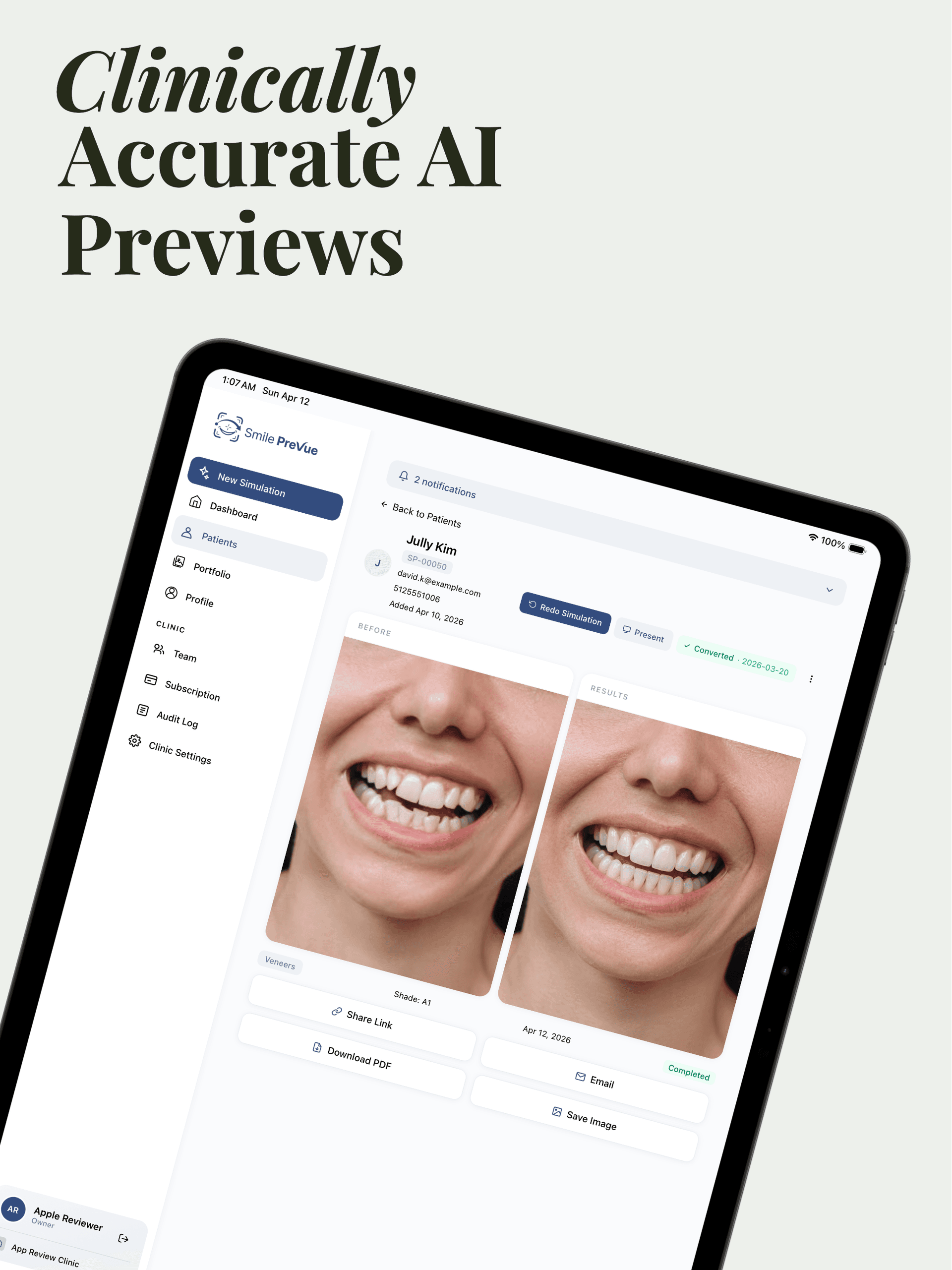 AI Smile Simulation